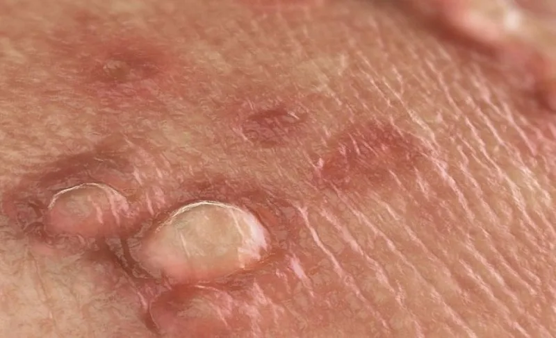 hpv la benh gi dau hieu nhan biet va bien chung nguy hiem