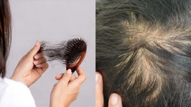 Tóc rụng nhiều đáng lo khi đường ngôi rộng, tóc mỏng nhanh hoặc da đầu lộ rõ hơn trước.