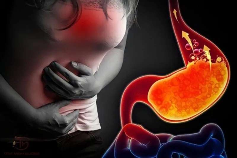 Trào ngược dạ dày thực quản xảy ra khi dịch trong dạ dày đi ngược lên thực quản, gây ợ nóng, ợ chua và nhiều triệu chứng khó chịu.